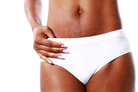 PRP for Stretch Marks Clifton, NJ