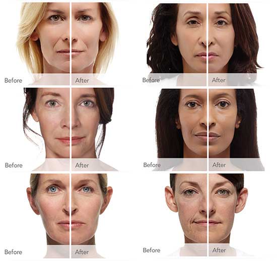 Radiesse Filler Injections in Knightdale, NC