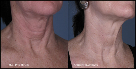 SkinTyte Skin Resurfacing Treatment by Sciton in Clifton, NJ