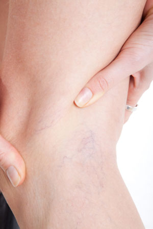 Microphlebectomy Varicose Vein Surgery in Clifton, NJ